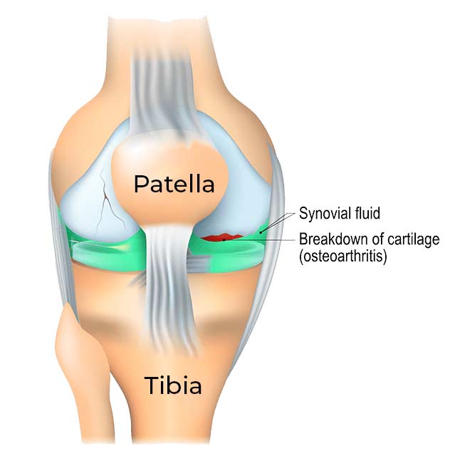 Knee joint diagram showing how gel injection restores cartilage cushion